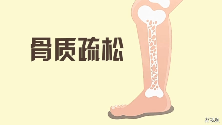 骨质疏松怎么补钙？骨科专家来支招