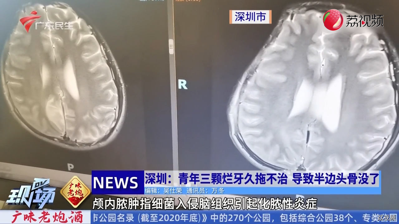 三颗烂牙让小伙躺进重症监护室？ 小小的细菌有巨大的危害