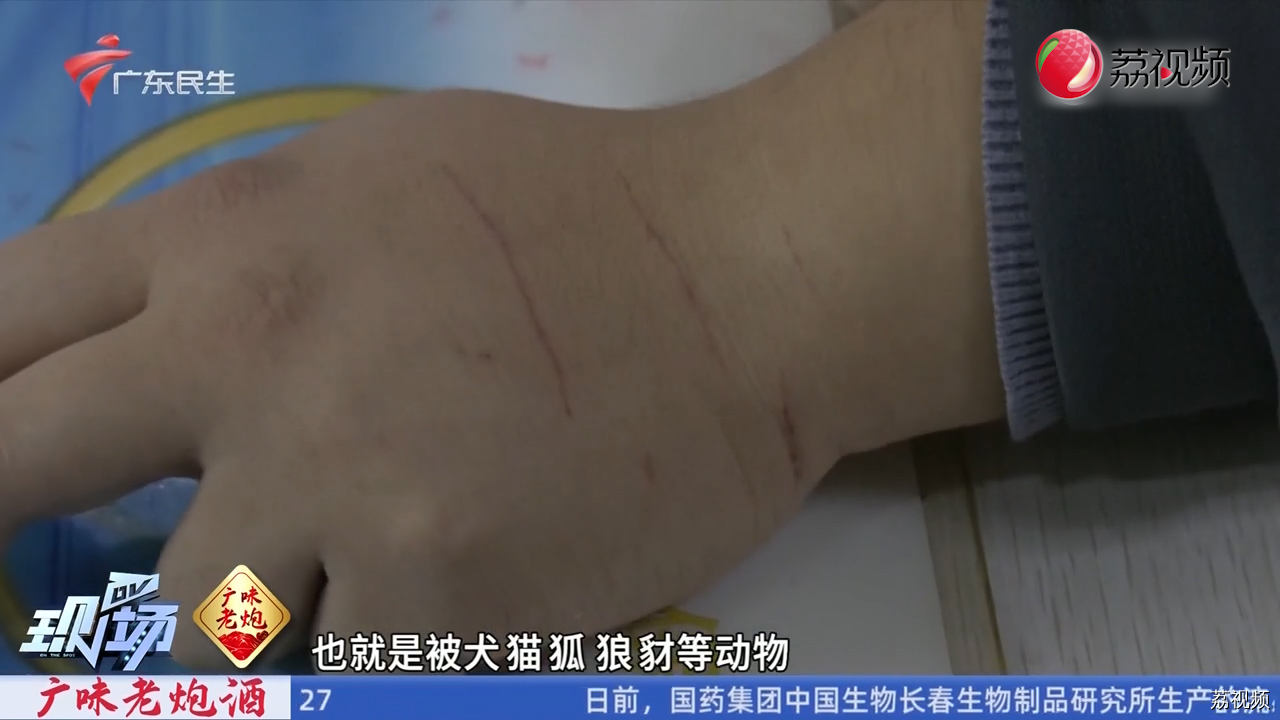 口吸毒素不是“烂漫” 而是狂犬病三级暴露