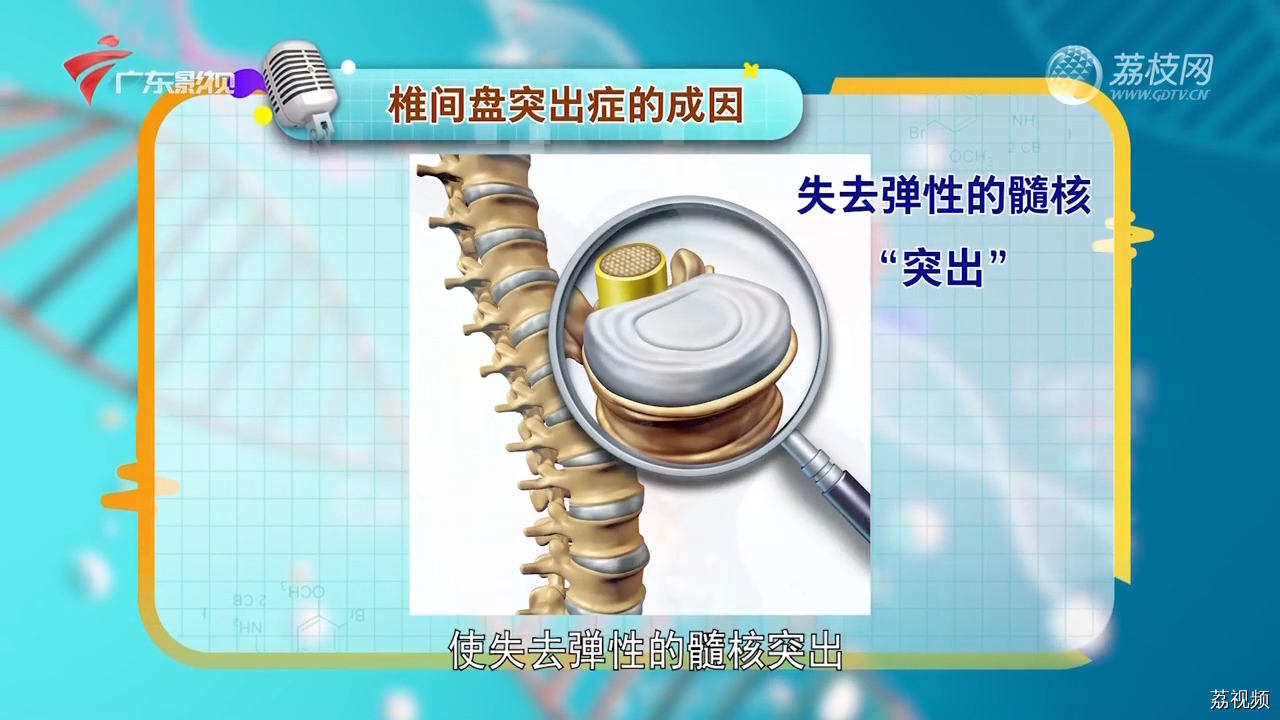 一个喷嚏半身不遂？医生：警惕椎间盘突出