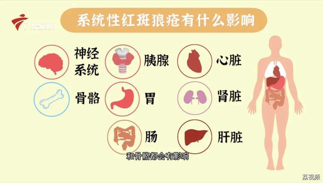 演员周海媚因病去世！红斑狼疮真的是不治之症吗？