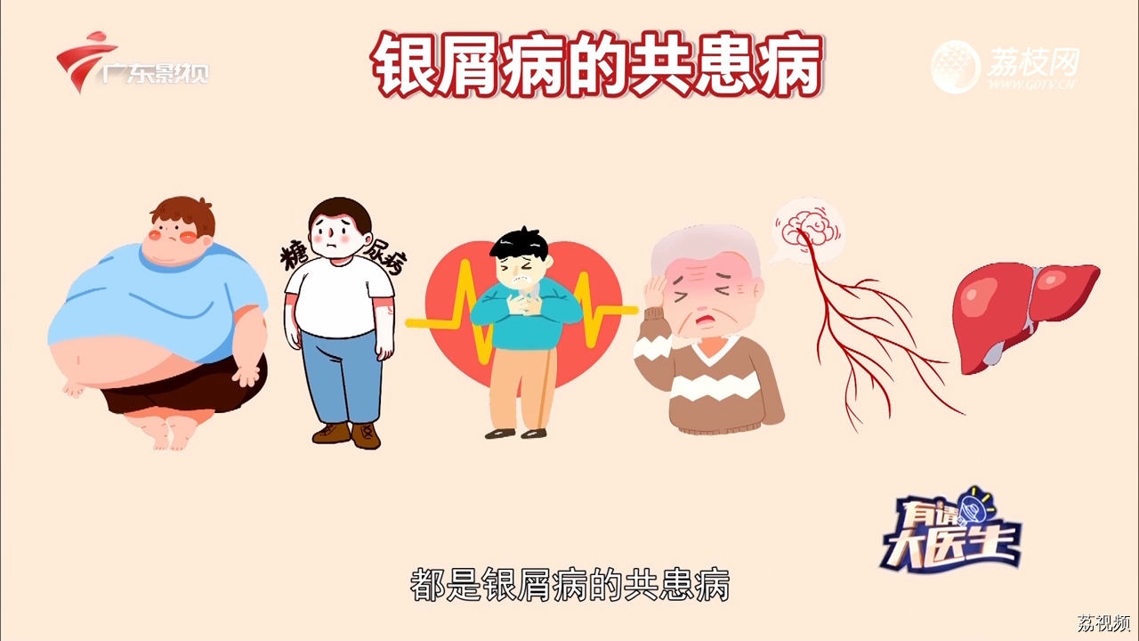 医学小科普：银屑病是什么