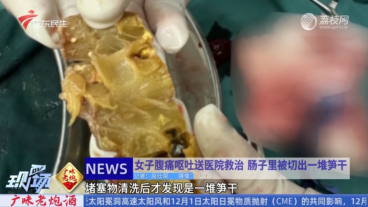 笋干造成肠子梗阻？医生：食用粗纤维食品需适量