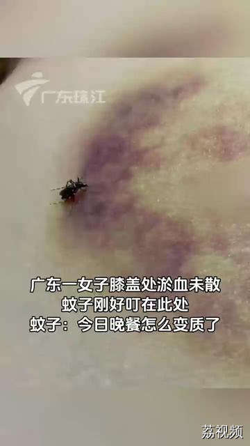 近日，广东一女子膝盖处受伤淤血未散，蚊子刚好叮在此处，吸走部分淤血。蚊子：今日的晚餐怎么变质了？