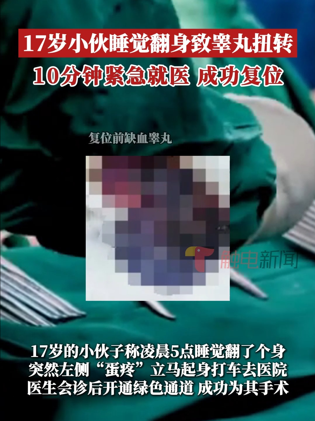 17岁小伙睡觉翻身致睾丸扭转，就医时已缺血呈暗紫色