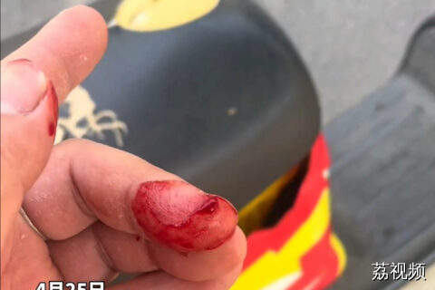 共享单车疑藏钢针，男子手被划出一道伤口，出血量明显