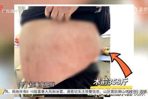 355斤男子太胖只能轮椅出门，腹围166厘米比不少成人还高