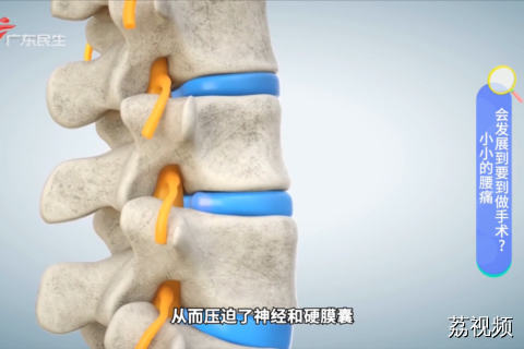 小小的腰痛 会发展到要到做手术？