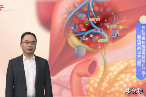 胆结石的诞生过程 病在胆囊 致病原因竟然在肝脏！