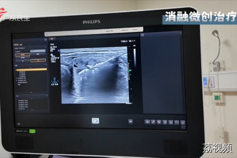 微创消融法如何“拆弹”